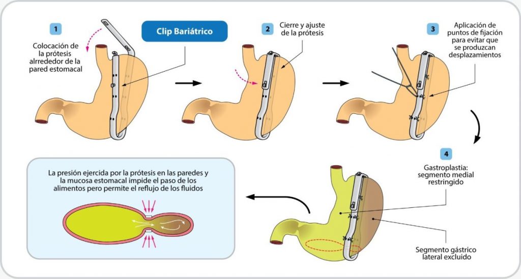 image-1366x733 - Instituto de Obesidad